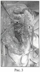 Способ лечения разгибательной контрактуры локтевого сустава у больных с артрогрипозом (патент 2458647)
