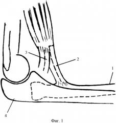 Способ открытого вправления головки лучевой кости при ее заднем вывихе у детей (патент 2328995)