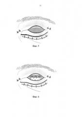 Способ устранения паралитического лагофтальма (патент 2635082)