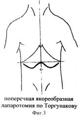 Способ поперечной лапаротомии (патент 2367362)
