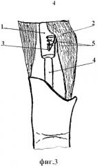 Способ тендопластики глубокого сгибателя пальца (патент 2322952)