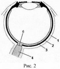 Способ получения культуры клеток ретинального пигментного эпителия из глаза взрослого донора-трупа (патент 2569481)