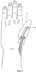 Способ реконструкции первого пальца при тотальных дефектах лучевого края кисти (патент 2534851)