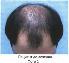 Способ трансплантации волос (патент 2550428)