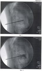 Способ перкутанной вертебропластики при травмах и заболеваниях позвоночника (патент 2432137)