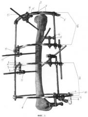 Аппарат внешней фиксации для лечения переломов, ложных суставов и несросшихся переломов костей (патент 2375984)
