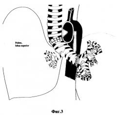 Способ реконструкции бифуркации трахеи после циркулярной резекции карины и левого главного бронха (патент 2270616)