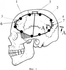 Способ створчатой трепанации черепа (патент 2640996)