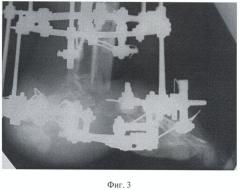 Способ реконструкции заднего отдела стопы после удаления остеомиелитически пораженной пяточной кости (патент 2381760)