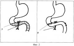 Способы хирургического лечения хронической дуоденальной непроходимости (варианты) (патент 2264179)