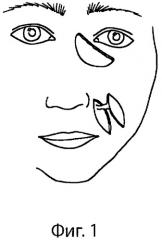 Способ закрытия обширных дефектов кожи век, распространяющихся на область внутреннего угла глаза и окружающие зоны лица (патент 2303968)