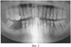 Дентальный внутрикостный имплантат (патент 2376955)