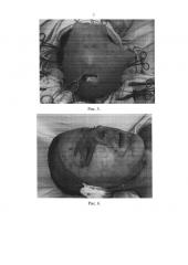 Способ пластики полнослойным кожным аутотрансплантатом (патент 2655201)