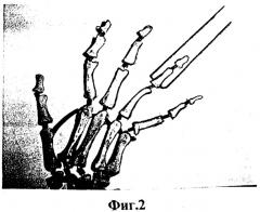 Способ лечения повреждения сухожилия разгибателя пальца кисти на уровне дистальных межфаланговых суставов (патент 2323693)