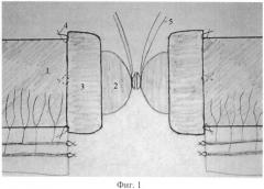 Способ формирования компрессионного межкишечного анастомоза (патент 2401075)