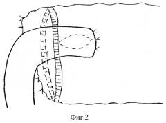 Способ усиления запирательной функции тонкотолстокишечного анастомоза (патент 2253390)