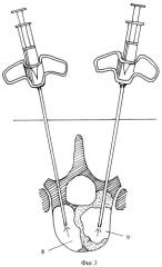 Способ малоинвазивного хирургического лечения опухолей позвонков (патент 2353315)