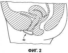 Интерлабиальная прокладка (патент 2286757)