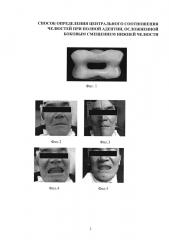 Способ определения центрального соотношения челюстей при полной адентии, осложненной боковым смещением нижней челюсти (патент 2613721)