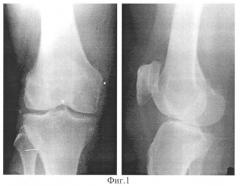Способ диагностики тяжести остеоартроза коленного сустава (патент 2332923)