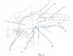 Способ поперечного пересечения поджелудочной железы (патент 2476162)