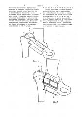 Способ пластики капсулы тазобедренного сустава (патент 1362465)