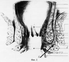 Способ склеротерапии анальных трещин (патент 2266108)
