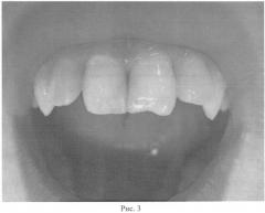 Способ диагностики начального кариеса зубов (патент 2538614)