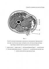 Способ установки имплантата бедра (патент 2626271)