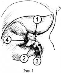 Способ анатомической резекции iv сегмента печени (патент 2442541)
