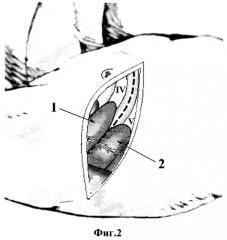 Способ боковой торакотомии (патент 2336031)