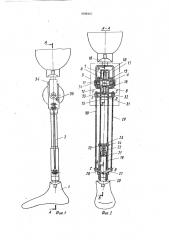 Протез бедра (патент 1648447)