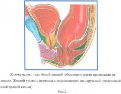 Способ трансанальной резекции прямой кишки при болезни гиршпрунга у детей (патент 2410046)