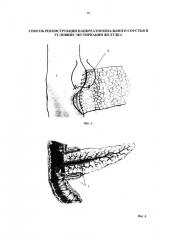 Способ реконструкции панкреатоеюнального соустья в условиях экстирпации желудка (патент 2641167)