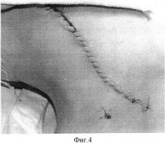 Способ хирургического доступа для удаления клетчатки и лимфатических узлов шеи (патент 2318455)