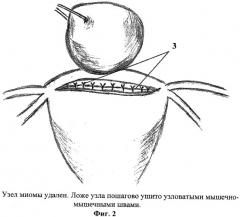 Способ удаления миомы матки (патент 2411008)