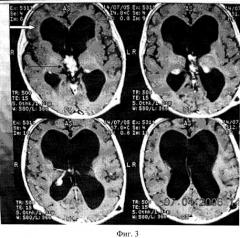Способ отведения ликвора из полости черепа у детей с гидроцефалией (патент 2321355)
