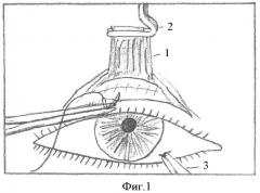 Способ хирургического лечения птоза верхнего века (патент 2360653)