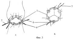 Способ хирургического лечения аневризм корня аорты с сохранением собственного клапана (патент 2294703)