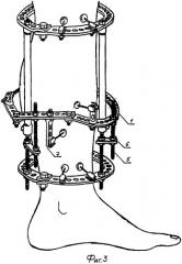 Аппарат для первичного внеочагового остеосинтеза переломов голени (патент 2264188)