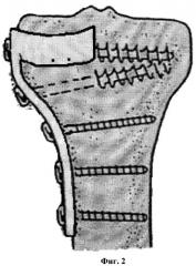 Устройство для остеосинтеза мыщелков большеберцовой кости (патент 2332185)