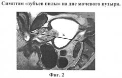 Способ диагностики гиперактивного мочевого пузыря у пациентов с аденомой предстательной железы (патент 2567607)