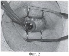 Способ хирургического лечения рецидивирующего птеригиума (патент 2354338)