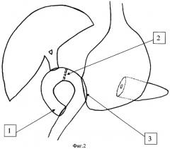 Способ панкреатодуоденальной резекции (патент 2290885)