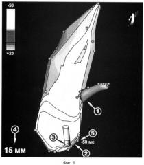 Способ радиочастотной аблации очага эктопической тахикардии в выводном отделе левого желудочка (патент 2428109)