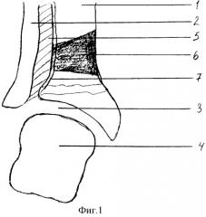 Способ лечения деформации голеностопного сустава (патент 2271167)