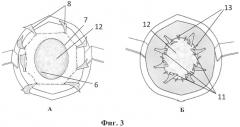 Способ аллопластики при послеоперационных вентральных грыжах (патент 2570760)