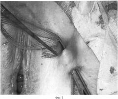 Способ хирургического лечения опущения передней стенки влагалища у женщин с высоким риском рецидива после экстирпации матки (патент 2499570)
