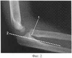 Способ закрытого вправления пронационного подвывиха головки лучевой кости у детей (патент 2405492)