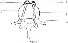 Способ фиксации нестабильных повреждений позвоночника (патент 2428947)